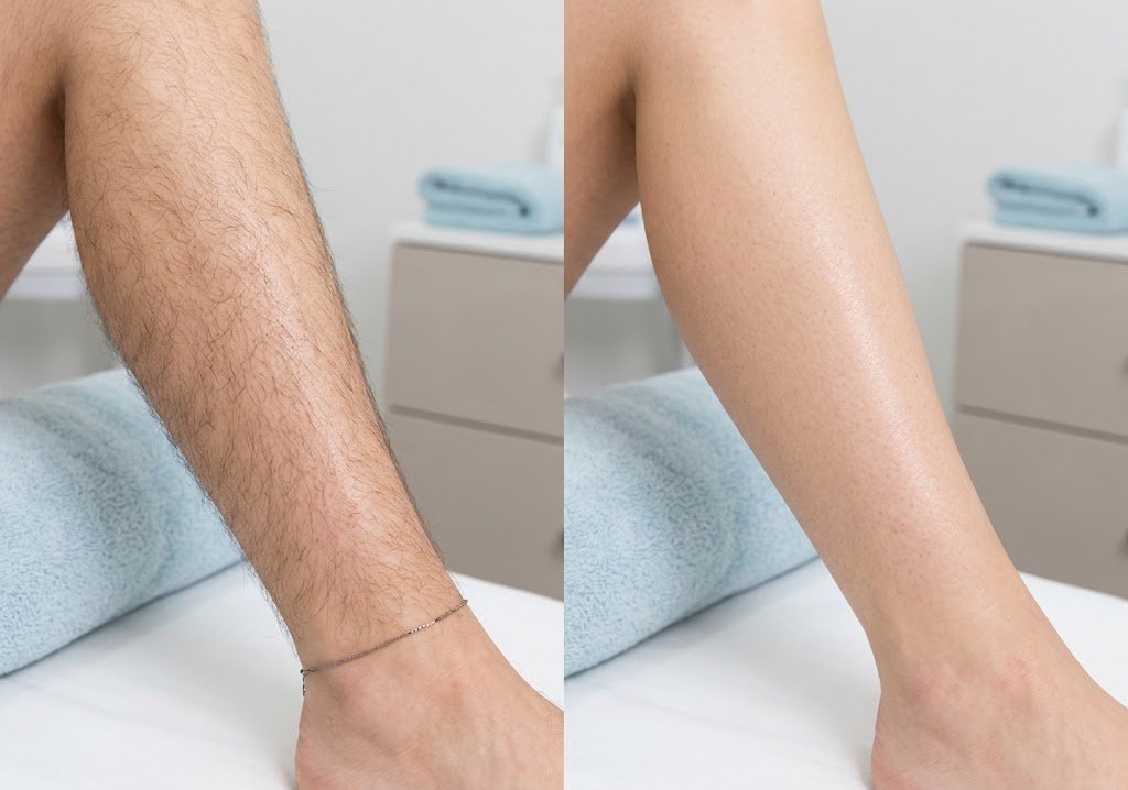 Before and after laser hair removal