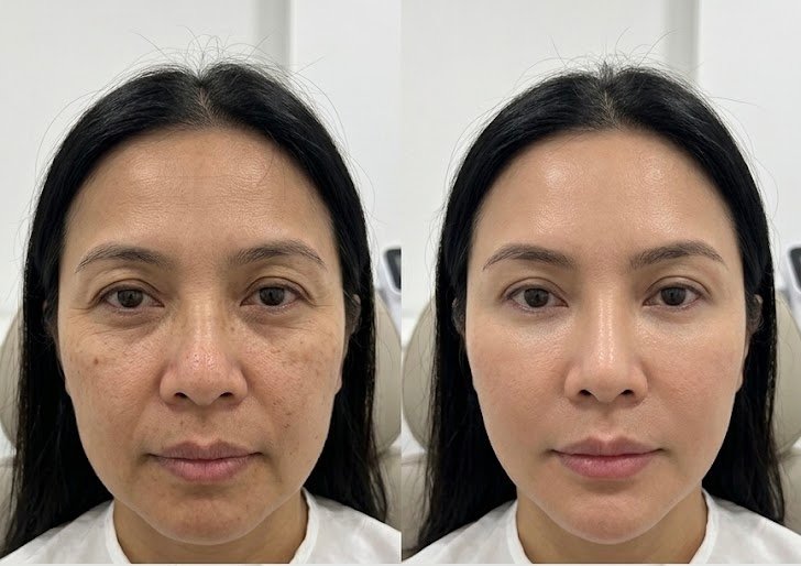 Before and after skin rejuvenation